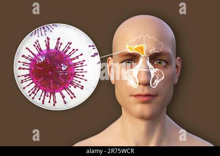Virale Sinusitis, Computerdarstellung. Sinusitis, auch als Sinusinfektion oder Rhinosinusitis bezeichnet, ist eine Entzündung der Nasennebenhöhlen, die zu einem Symp führt Stockfoto