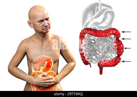 Bauchschmerzen und Krämpfe bei einem Mann durch Reizdarmsyndrom (RDS), konzeptionelle Computerdarstellung mit hervorgehobenem Darm und Isolat Stockfoto