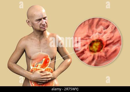 Magenschmerzen, konzeptionelle Computerdarstellung. Ein Mann mit Ulcus ventriculi mit hervorgehobenen inneren Organen und Magengeschwür aus der Nähe. Stockfoto