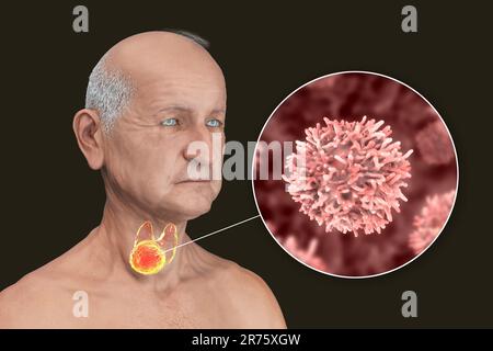 Schilddrüsenkrebs mit Nahaufnahme von Krebszellen, Computerdarstellung. Stockfoto