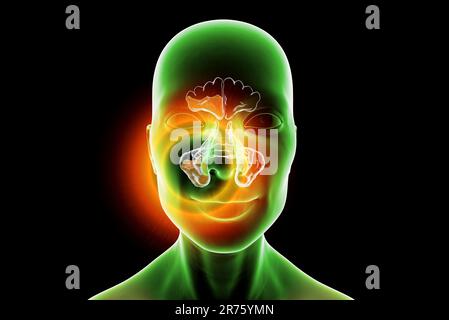 Sinusitis, Computerdarstellung. Die Nasennebenhöhlen sind membrangesäumte, luftgefüllte Räume in den Knochen des Gesichts. Die Stirnhöhlen befinden sich über den Augen. B Stockfoto