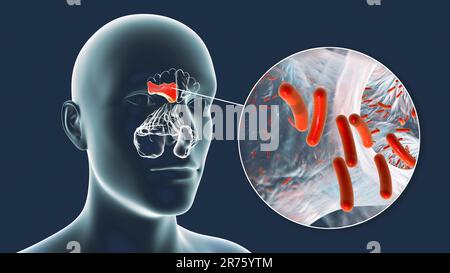 Bakterielle Sinusitis, Computerdarstellung. Die Nasennebenhöhlen sind membrangesäumte, luftgefüllte Räume in den Knochen des Gesichts. Die Stirnhöhlen liegen über t Stockfoto