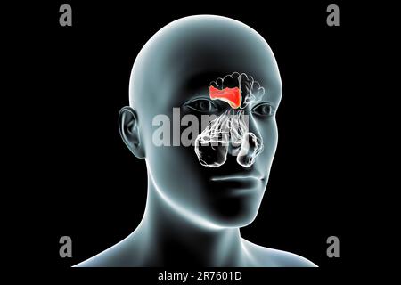 Sinusitis, Computerdarstellung. Die Nasennebenhöhlen sind membrangesäumte, luftgefüllte Räume in den Knochen des Gesichts. Die Stirnhöhlen befinden sich über den Augen. B Stockfoto