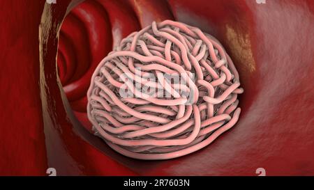 Runde Würmer im menschlichen Darm, Computer-Illustration. Fadenwürmer, oder Nematoden, umfassen zahlreiche freilebende und pathogene Arten. Nematoden, die c Stockfoto