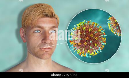 Lippenherpes an der Lippe eines Mannes und Nahaufnahme von Herpes simplex-Viren, Computerdarstellung. Lippenherpes sind schmerzhafte, mit Flüssigkeit gefüllte Blasen verursacht Stockfoto