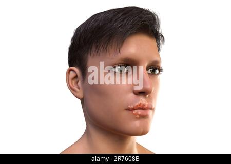 Fieberbläschen an der Lippe eines Mannes, Computerdarstellung. Lippenherpes sind schmerzhafte, mit Flüssigkeit gefüllte Blasen, die durch eine Infektion mit dem Herpes-simplex-Virus verursacht werden. Stockfoto