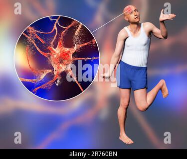 Eine Person mit Chorea-Krankheit und Nahaufnahme des neuronalen Abbaus, der durch choreiforme Bewegungen entsteht, konzeptionelle Computerdarstellung. Stockfoto