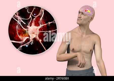 Eine Person mit Chorea-Krankheit und Nahaufnahme des neuronalen Abbaus, der durch choreiforme Bewegungen entsteht, konzeptionelle Computerdarstellung. Stockfoto