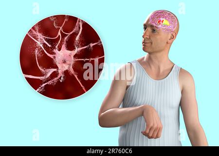 Eine Person mit Chorea-Krankheit und Nahaufnahme des neuronalen Abbaus, der durch choreiforme Bewegungen entsteht, konzeptionelle Computerdarstellung. Stockfoto