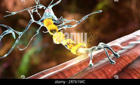 Demyelinisierung des neurons, die Schädigung der neuronenmyelinscheide bei demyelinisierenden Erkrankungen wie Multipler Sklerose und anderen demyelinisierenden Myelinen Stockfoto