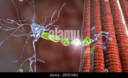 Demyelinisierung des neurons, die Schädigung der neuronenmyelinscheide bei demyelinisierenden Erkrankungen wie Multipler Sklerose und anderen demyelinisierenden Myelinen Stockfoto