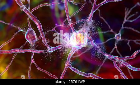 Zerstörung von Neuronen des dorsalen Striatums, konzeptuelle Computerdarstellung. Das dorsale Striatum ist ein Zellkern in den Basalganglien des Gehirns, dessen Neuronen es sind Stockfoto