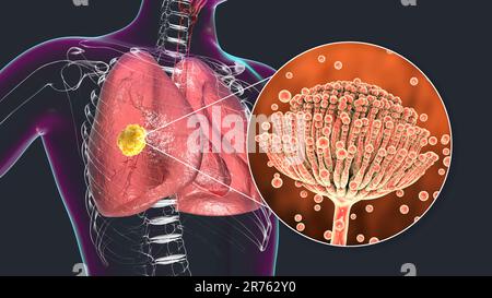 Pulmonale Aspergillose, Eindringen von Lungengewebe durch Schimmelpilze Aspergillus mit Nahaufnahme der Pilze, Computerdarstellung. Stockfoto