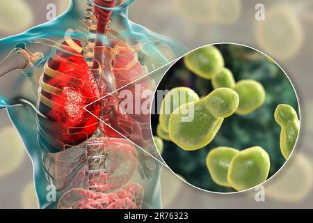 Pulmonale Kryptokokkose, Eindringen von Lungengewebe durch Hefepilze Cryptococcus neoformans mit Nahaufnahme der Pilze, Computerdarstellung. Stockfoto