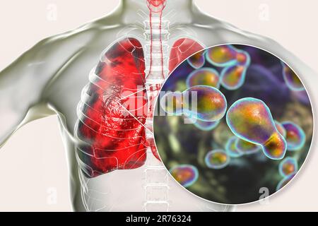 Pulmonale Kryptokokkose, Eindringen von Lungengewebe durch Hefepilze Cryptococcus neoformans mit Nahaufnahme der Pilze, Computerdarstellung. Stockfoto