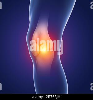 Schmerzen im menschlichen Knie, Computer Bild. Stockfoto