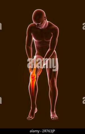 Schmerzen im menschlichen Knie, Computer Bild. Stockfoto