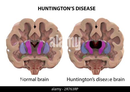 Dorsales Striatum und laterale Ventrikel im gesunden Gehirn und bei der Huntington-Krankheit (HD). Computerdarstellung mit Vergrößerung des vorderen ho Stockfoto