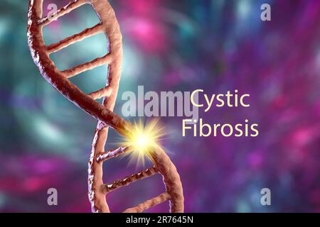 Illustration der zystischen Fibrose, eine erbliche Erkrankung (auch Mukoviszidose genannt) führt dazu, dass die Atemwege (Bronchien) mit Schleim, Cauzin verstopft Stockfoto