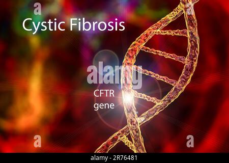 Illustration der zystischen Fibrose, eine erbliche Erkrankung (auch Mukoviszidose genannt) führt dazu, dass die Atemwege (Bronchien) mit Schleim, Cauzin verstopft Stockfoto