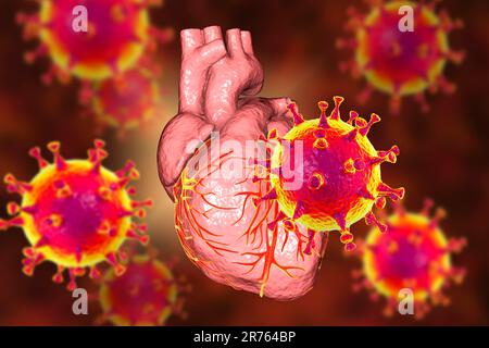 COVID-19-Viren am Herzen, konzeptionelle 3D-Illustration. Entzündungen des Herzens und anderer Organe können eine Komplikation von Covid-19, A bzw. Stockfoto