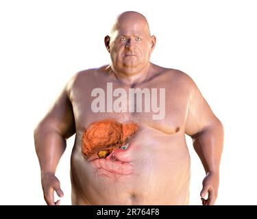 Fibrotische Leber bei adipösem Mann, Computerdarstellung. Stockfoto