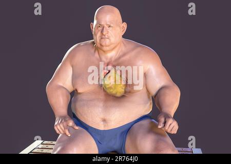 Computer Abbildung eines Fettsäuren Herz in einem übergewichtigen Menschen. Stockfoto