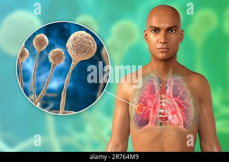 Pulmonale Mucormykose (oder Zygomykose), eine Lungenerkrankung, die durch Mucor sp.-Pilze, auch als schwarzer Pilz bekannt, mit Nahaufnahme der Pilze, Komput, verursacht wird Stockfoto