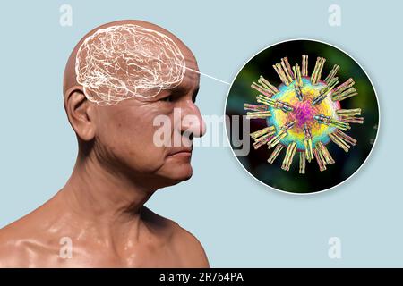 Infektiöse Atiologie der Demenz. Konzeptionelle Computerdarstellung einer älteren Person mit fortschreitender Beeinträchtigung der Gehirnfunktionen, Amyloid p Stockfoto