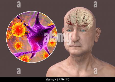 Infektiöse Atiologie der Demenz. Konzeptionelle Computerdarstellung einer älteren Person mit fortschreitender Beeinträchtigung der Gehirnfunktionen, Amyloid p Stockfoto