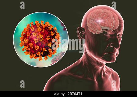 Covid-19 und Demenz. Neuropsychiatrische Folgen von Covid-19, konzeptionelle Computerdarstellung. Infektiöse Atiologie der Demenz. Ein alter Mensch mit Witz Stockfoto