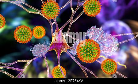 Covid-19 und Demenz, neuropsychiatrische Folgen von Covid-19, konzeptionelle Computerdarstellung mit neuronschädigenden Coronaviren und Amyloidplaq Stockfoto