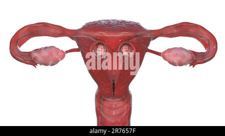 Mehrlingsschwangerschaft. Eigenständig im Uterus entstehende dizygote Zwillinge. Woche 8. Stockfoto