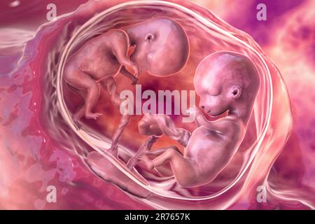 Mehrlingsschwangerschaft, Illustration. Eineiige Zwillinge im Uterus mit derselben Plazenta. Frühe fetale Periode, Woche 8 bis Woche 16. Stockfoto