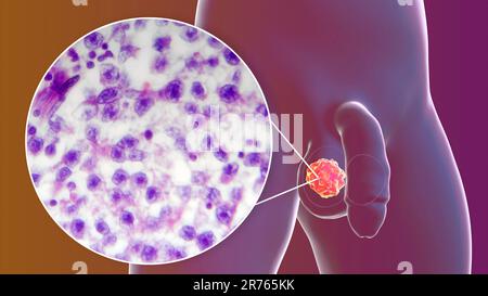 Hodenkrebs, ein maligner Spermatozytenvorfall, Computerdarstellung und leichte Mikrograph. Ein Seminom ist ein bösartiger Tumor (Krebs) der te Stockfoto