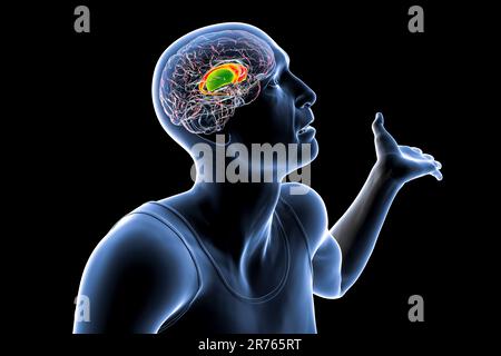 Dorsales Striatum, Nucleus caudatus und Putamen, hervorgehoben im Gehirn einer Person mit Huntington-Krankheit mit unwillkürlichen Bewegungen, konzeptionelle CO Stockfoto