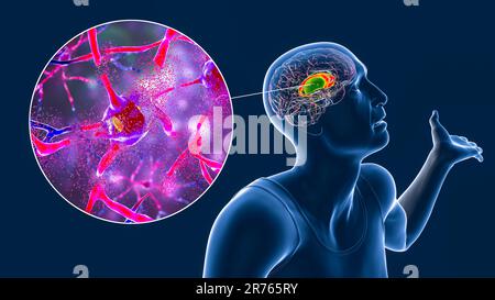 Dorsales Striatum, Nucleus caudatus und Putamen, hervorgehoben im Gehirn einer Person mit Huntington-Krankheit mit unwillkürlichen Bewegungen, und Nahaufnahme Stockfoto