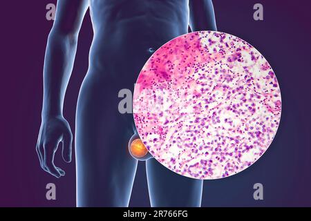 Hodenkrebs, ein maligner Spermatozytenvorfall, Computerdarstellung und leichte Mikrograph. Ein Seminom ist ein bösartiger Tumor (Krebs) der te Stockfoto