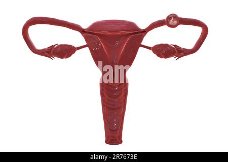 Ektopische Schwangerschaft, Illustration. Dies ist eine Schwangerschaft, bei der der Embryo außerhalb der Gebärmutter implantiert, in der Regel wie hier in der Eileiter, die c sollte Stockfoto