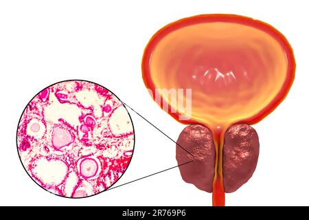 Lichtmikrographie (links) und Computerdarstellung (rechts) zeigen benigne Prostatahyperplasie. Hyperplasie beschreibt eine Zunahme der Zellzahl aufgrund von Stockfoto