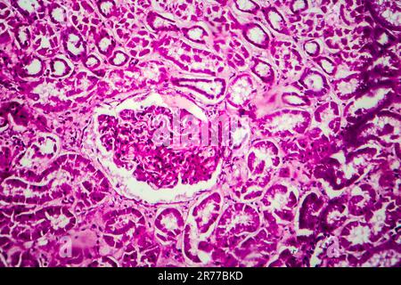 Glomerulonephritis. Lichtmikrographisches Nierengewebe bei diffuser sklerosierender Glomerulonephritis. Stockfoto