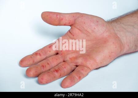 Schmerzhafter Ausschlag, rote Flecken Blasen an der Hand. Nahaufnahme Allergieausschlag, menschliche Hände mit Dermatitis und Gesundheitsproblem. Erkrankte Ekzemhaut des Patienten. Viral Stockfoto