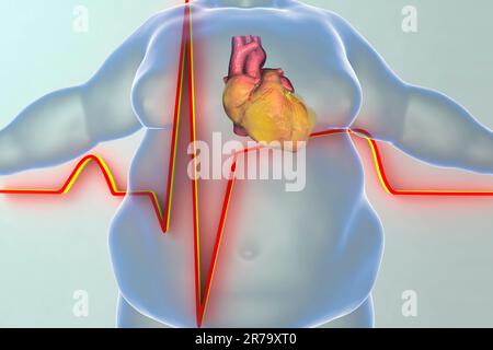 Herzkrankheit bei einer Person mit Adipositas, begriffliches Bild. 3D Abbildung zeigt einen Mann mit Gewichtszunahme und adipösem Herzen und EKG eines Myokardinfarkts Stockfoto