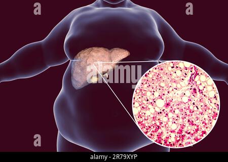 Adipöser Mann mit Fettleber, 3D-Darstellung und Photomikrogramm der Lebersteatose. Konzeptionelles Bild der nichtalkoholischen Fettlebererkrankung Stockfoto