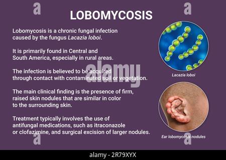 Lobomykose, eine chronische Hauterkrankung, die durch mikroskopische Pilze Lacazia loboi verursacht wird und durch noduläre und keloidale Läsionen gekennzeichnet ist, die primär Th Stockfoto