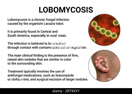 Lobomykose, eine chronische Hauterkrankung, die durch mikroskopische Pilze Lacazia loboi verursacht wird und durch noduläre und keloidale Läsionen gekennzeichnet ist, die primär Th Stockfoto