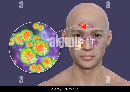 Moraxella-catarrhalis-Bakterien als Ursache einer Sinusitis. 3D Abbildung zeigt eitrige Entzündung der Stirn- und Kieferhöhlen und Nahaufnahme vi Stockfoto