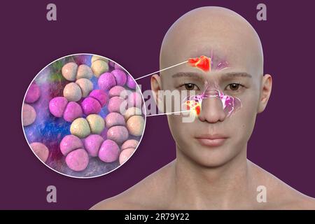 Streptococcus pneumoniae-Bakterien als Ursache einer Sinusitis. 3D Abbildung zeigt eitrige Entzündung der Stirn- und Kieferhöhlen und Nahaufnahme Stockfoto