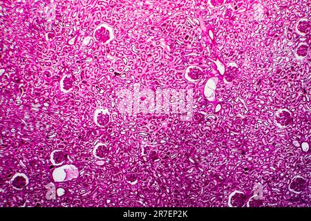 Glomerulonephritis. Lichtmikrographisches Nierengewebe bei diffuser sklerosierender Glomerulonephritis. Stockfoto