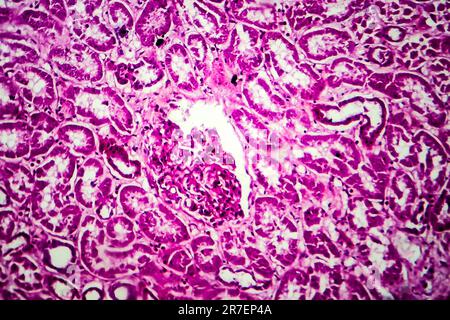 Glomerulonephritis. Lichtmikrographisches Nierengewebe bei diffuser sklerosierender Glomerulonephritis. Stockfoto